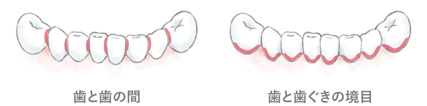 歯と歯の間、歯と歯ぐきの境目