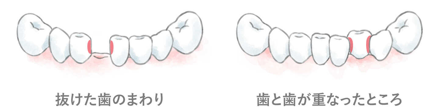 抜けた歯のまわり、歯と歯が重なったところ