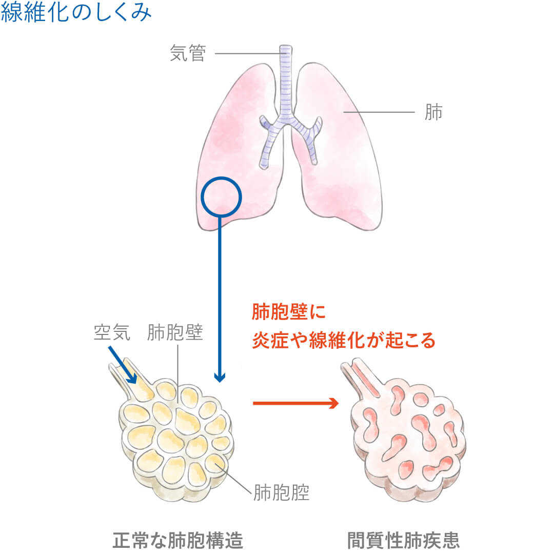 副作用に関する質問 間質性肺疾患とは? 線維化のしくみ 副作用に関する質問 間質性肺疾患とは? 線維化のしくみ