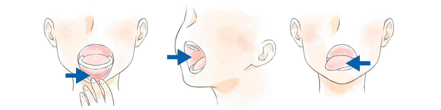 口内炎の起こりやすい唇の裏側、ほほの粘膜、舌の周囲(側面)の粘膜 口内炎の起こりやすい唇の裏側、ほほの粘膜、舌の周囲(側面)の粘膜