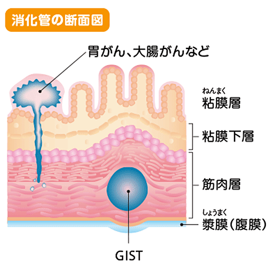消化管の断面図・がんとGIST（消化管間質腫瘍）の違いイメージ