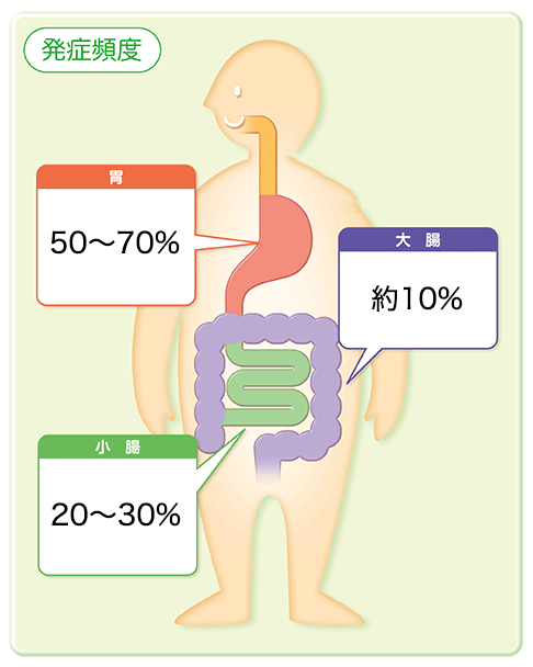 GIST（消化管間質腫瘍）のできる場所とその発症頻度イラスト