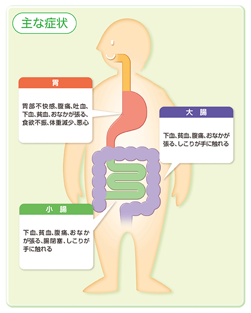 GIST(消化管間質腫瘍)のできる場所と主な症状イラスト