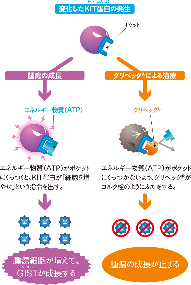 KIT蛋白の発生からGIST（消化管間質腫瘍）発生の仕組みとグリベック治療の仕組み