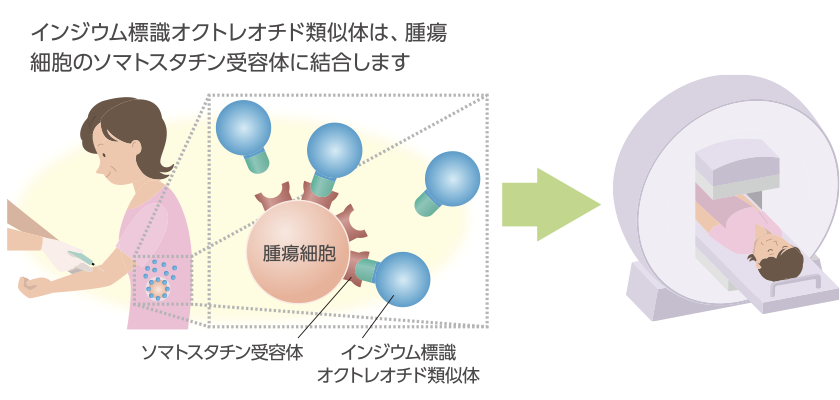 インジウム標識オクトレオチド類似体は、腫瘍細胞のソマトスタチン受容体に結合します