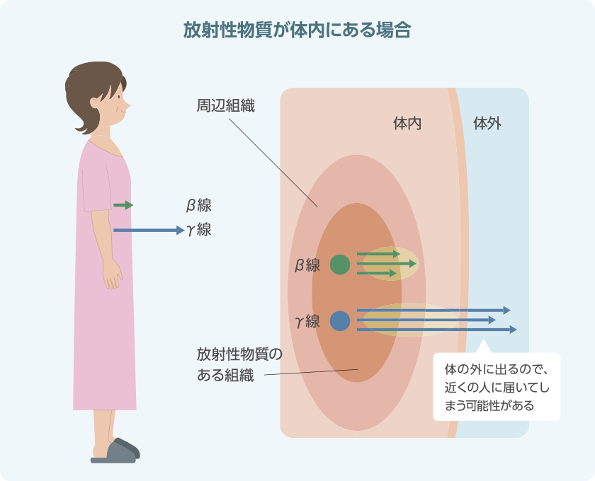 放射性物質が体内にある場合
