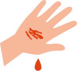 イラスト：⾎⼩板の減少による出⾎傾向