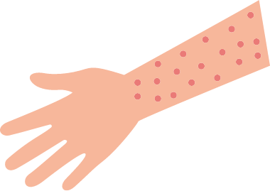 イラスト：発疹