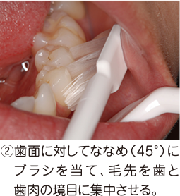 ②歯面に対してななめ（45°）にブラシを当て、毛先を歯と歯肉の境目に集中させる。