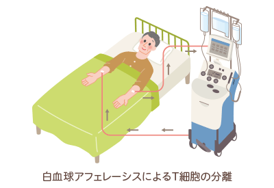 白血球アフェレーシスによるT細胞の分離 白血球アフェレーシスによるT細胞の分離