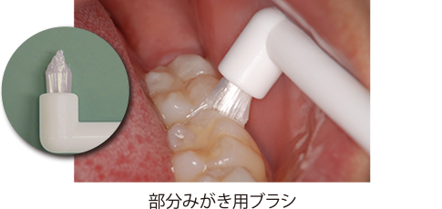 部分みがき用ブラシ