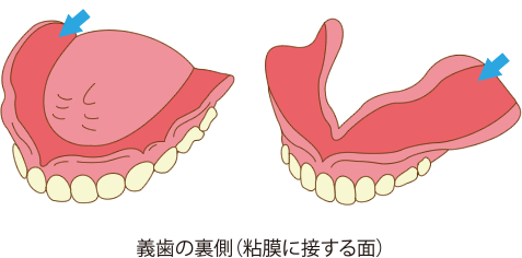 義歯の裏側（粘膜に接する面）