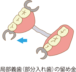 局部義歯（部分入れ歯）の留め具