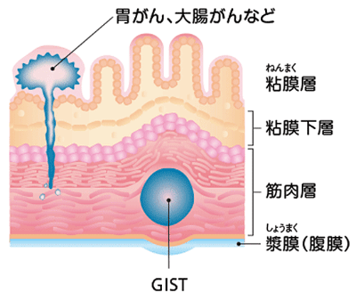 患者と家族にもよくわかるGIST(消化管間質腫瘍)ガイドブック Amazon.com: 患者と家族にもよくわかるGIST(消化管間質腫瘍