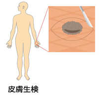 皮膚生検イラスト