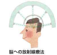 脳への放射線療法イメージ